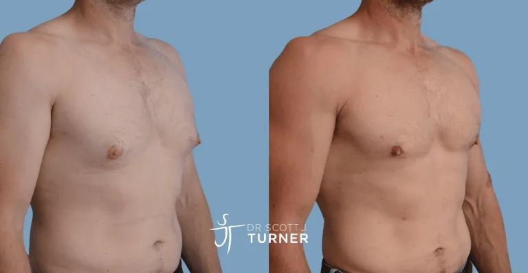 Bilateral gynaecomastia, gland excision and liposuction. Photos taken at 6 months postoperatively
