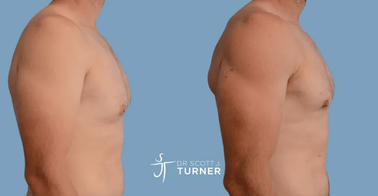 Bilateral gynaecomastia, gland excision and liposuction. Photos taken at 6 months postoperatively