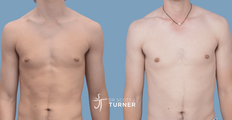 Bilateral gynaecomastia, direct gland excision. Photos taken at 6 months postoperatively