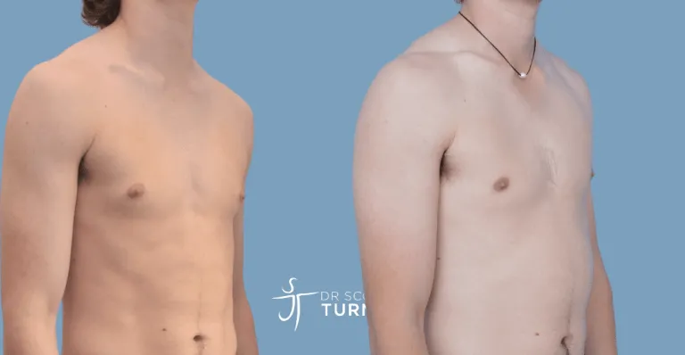 Bilateral gynaecomastia, direct gland excision. Photos taken at 6 months postoperatively