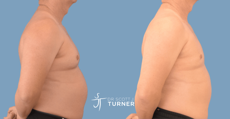 Bilateral gynaecomastia, gland excision and liposuction. Photos taken at 6 months postoperatively