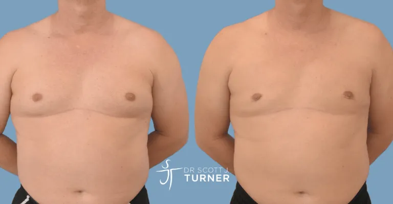 Bilateral gynaecomastia, gland excision and liposuction. Photos taken at 6 months postoperatively