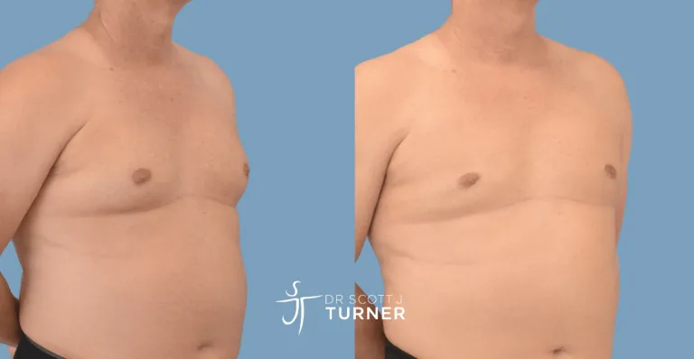 Bilateral gynaecomastia, gland excision and liposuction. Photos taken at 6 months postoperatively
