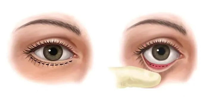Lower Blepharoplasty