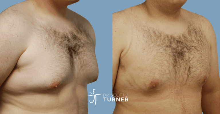 Bilateral gynaecomastia, gland excision and liposuction. Photos taken at 6 months postoperatively
