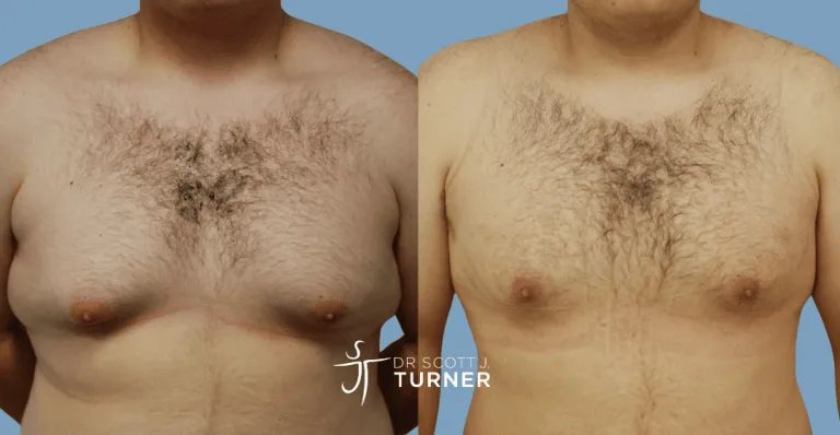 Bilateral gynaecomastia, gland excision and liposuction. Photos taken at 6 months postoperatively