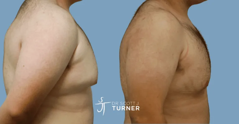 Bilateral gynaecomastia, gland excision and liposuction. Photos taken at 6 months postoperatively