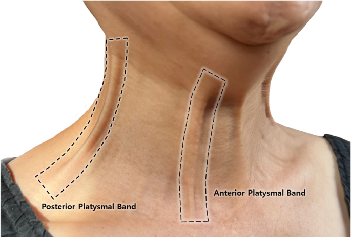 Platysmal Bands: What They Are, Why They Form and Treatment Options - 1