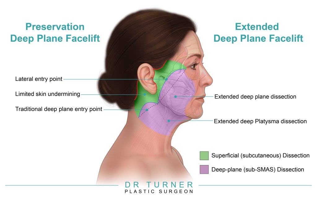 Deep Plane Facelift