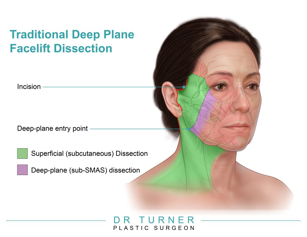 Deep Plane Facelift